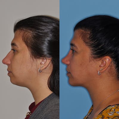 Chin Implants Before & After Gallery - Patient 179325 - Image 1