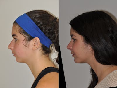 Chin Implants Before & After Gallery - Patient 355263 - Image 1