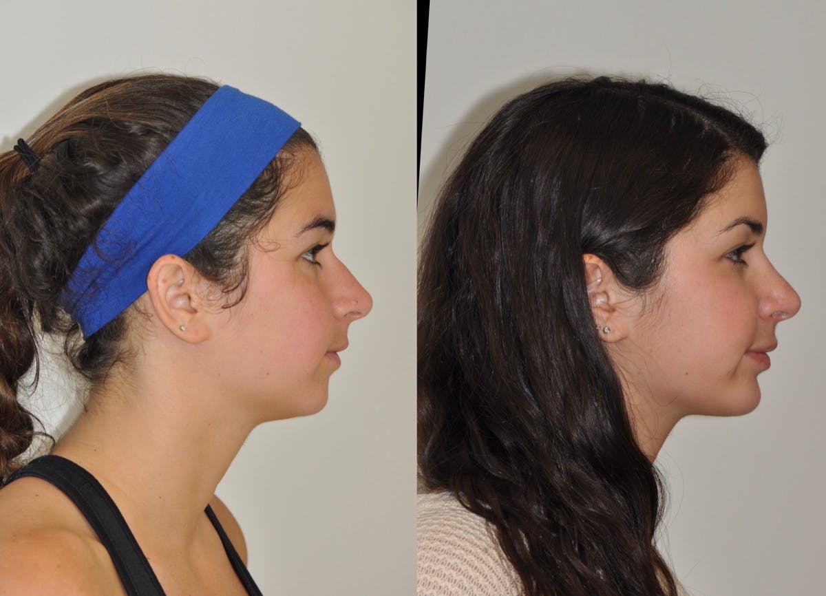 Chin Implants Before & After Gallery - Patient 355263 - Image 2