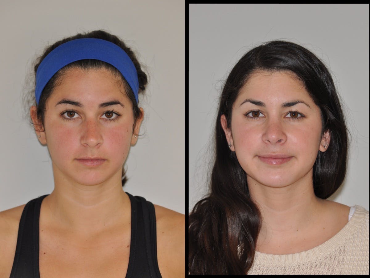 Chin Implants Before & After Gallery - Patient 355263 - Image 3