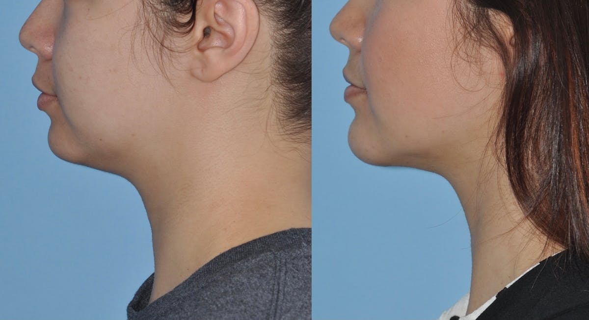 Chin Implants Before & After Gallery - Patient 296928 - Image 2