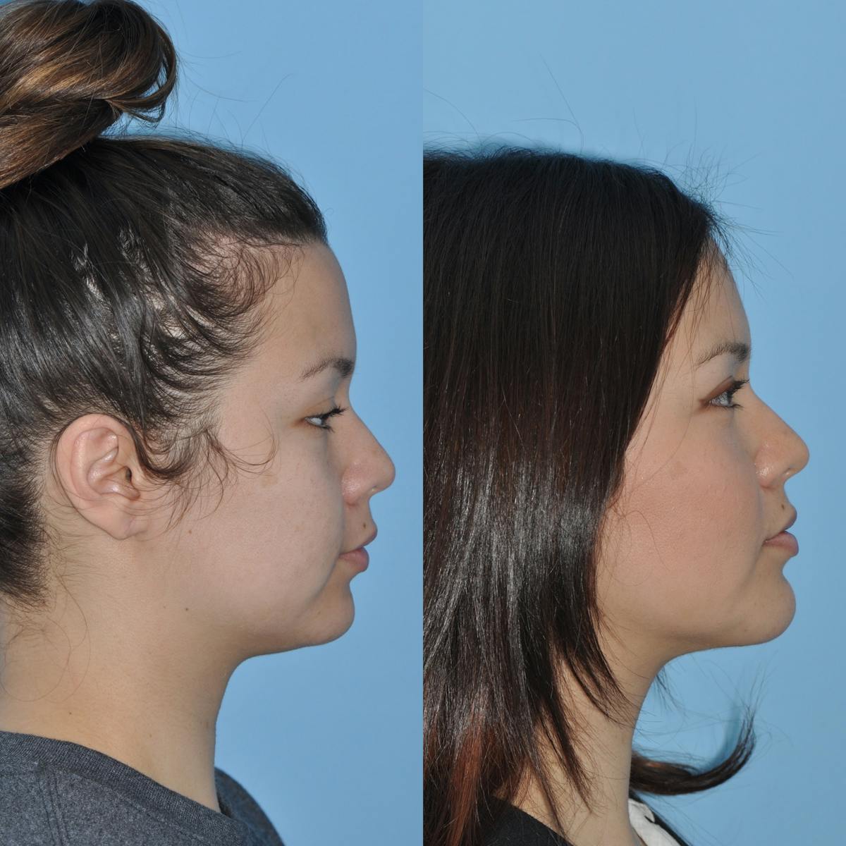 Chin Implants Before & After Gallery - Patient 296928 - Image 4