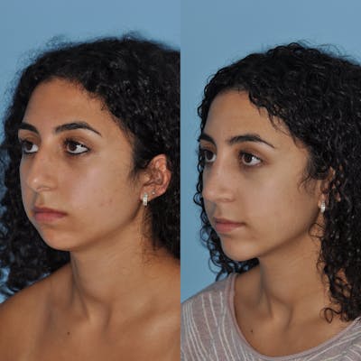 Chin Implants Before & After Gallery - Patient 225346 - Image 1