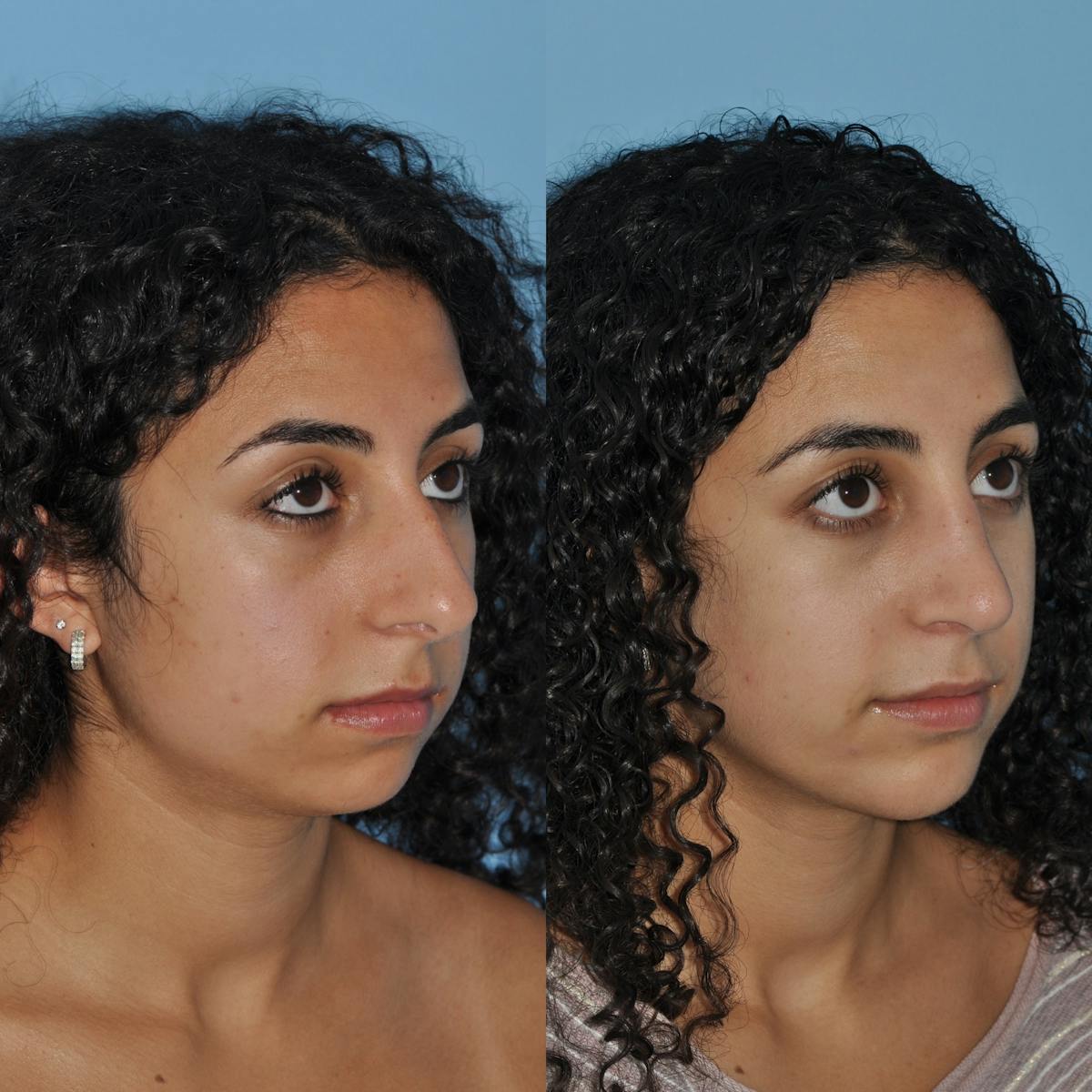 Rhinoplasty Before & After Gallery - Patient 213808 - Image 5