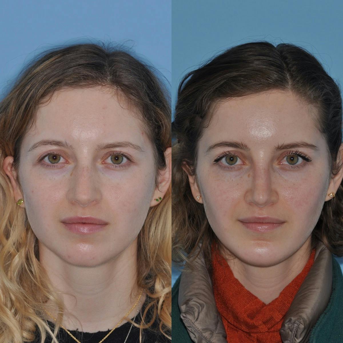 Chin Implants Before & After Gallery - Patient 927194 - Image 2
