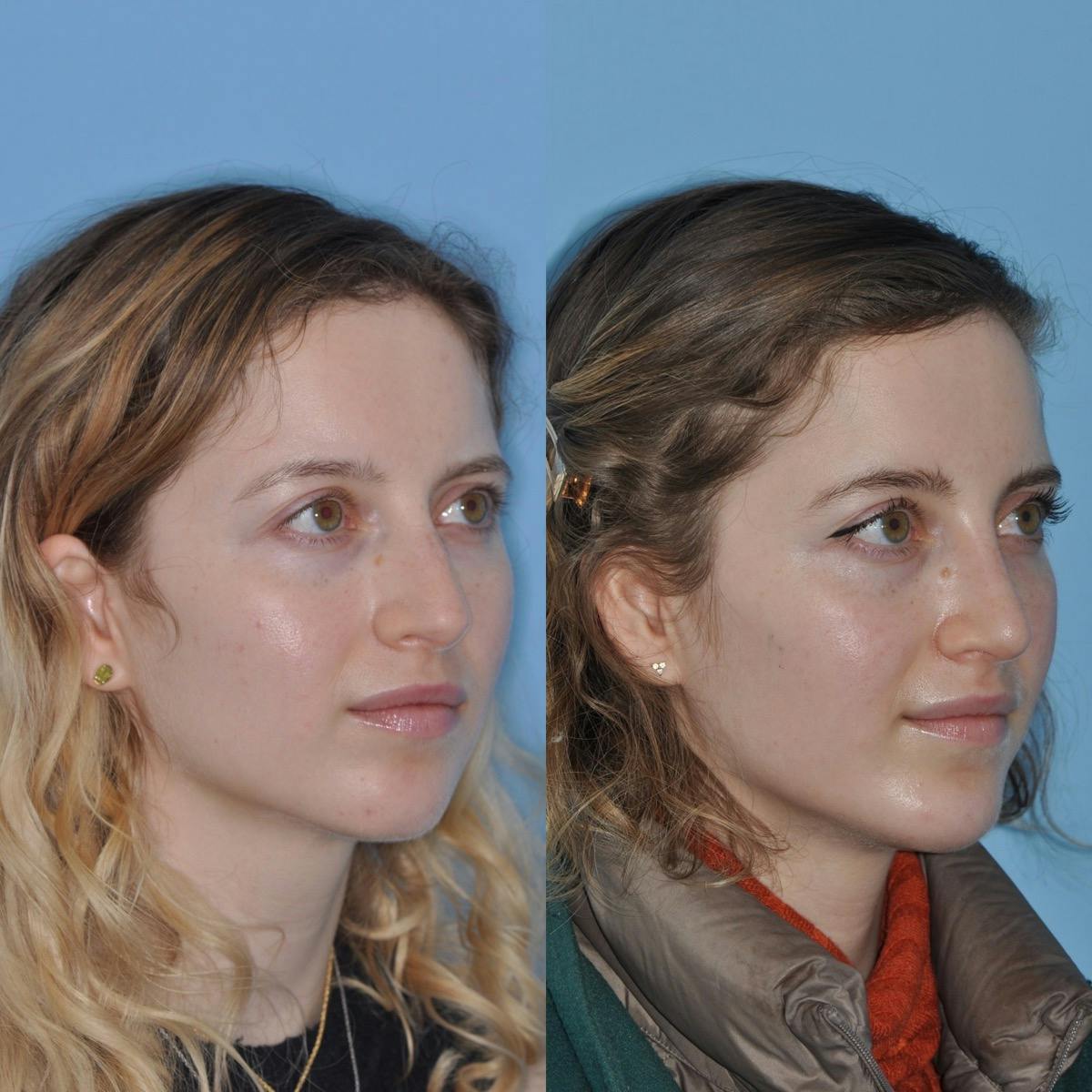 Chin Implants Before & After Gallery - Patient 927194 - Image 4