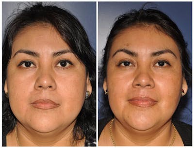 Chin Implants Before & After Gallery - Patient 210872 - Image 1