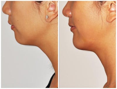 Chin Implants Before & After Gallery - Patient 243730 - Image 1