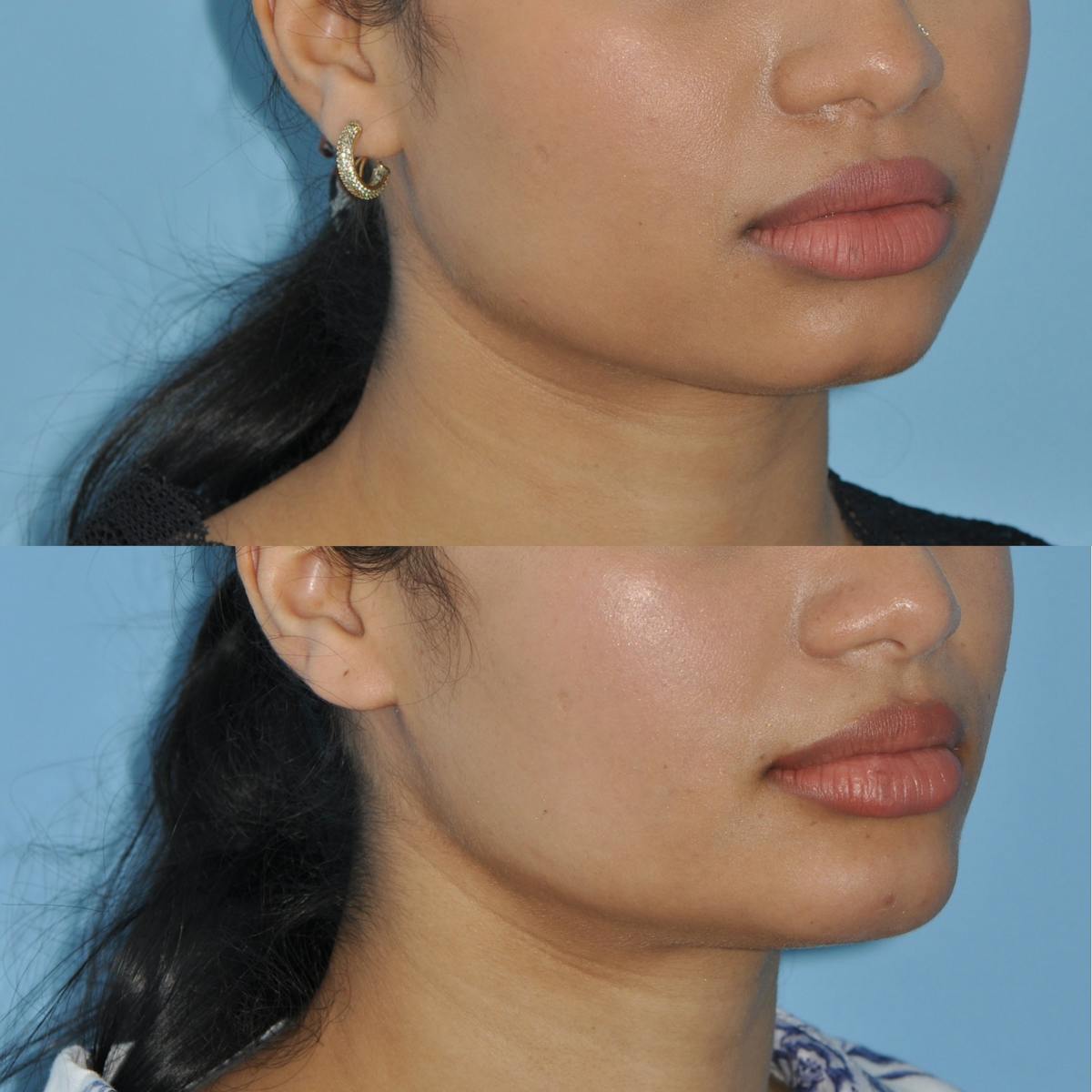 Chin Implants Before & After Gallery - Patient 384300 - Image 1