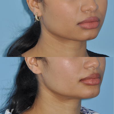 Chin Implants Before & After Gallery - Patient 384300 - Image 1