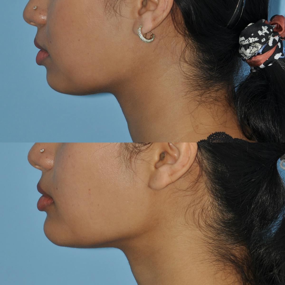 Chin Implants Before & After Gallery - Patient 384300 - Image 2