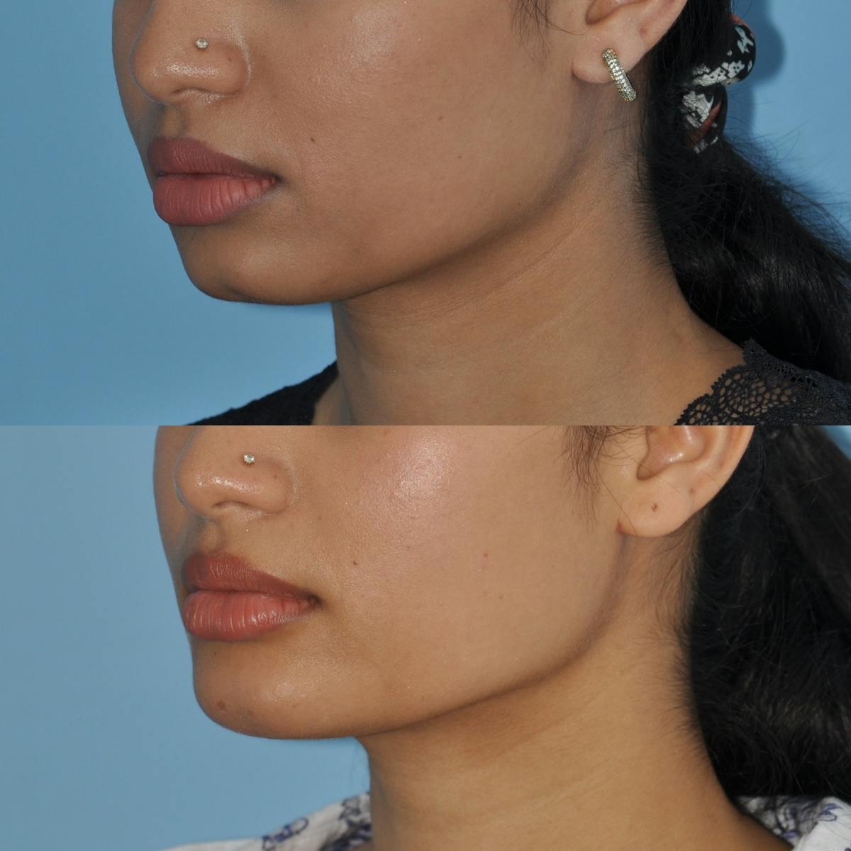 Chin Implants Before & After Gallery - Patient 384300 - Image 3
