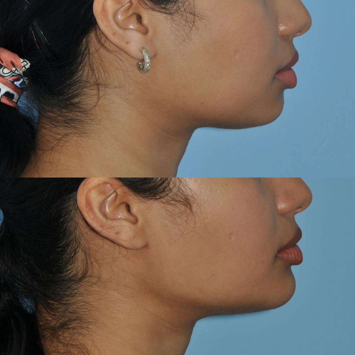 Chin Implants Before & After Gallery - Patient 384300 - Image 4