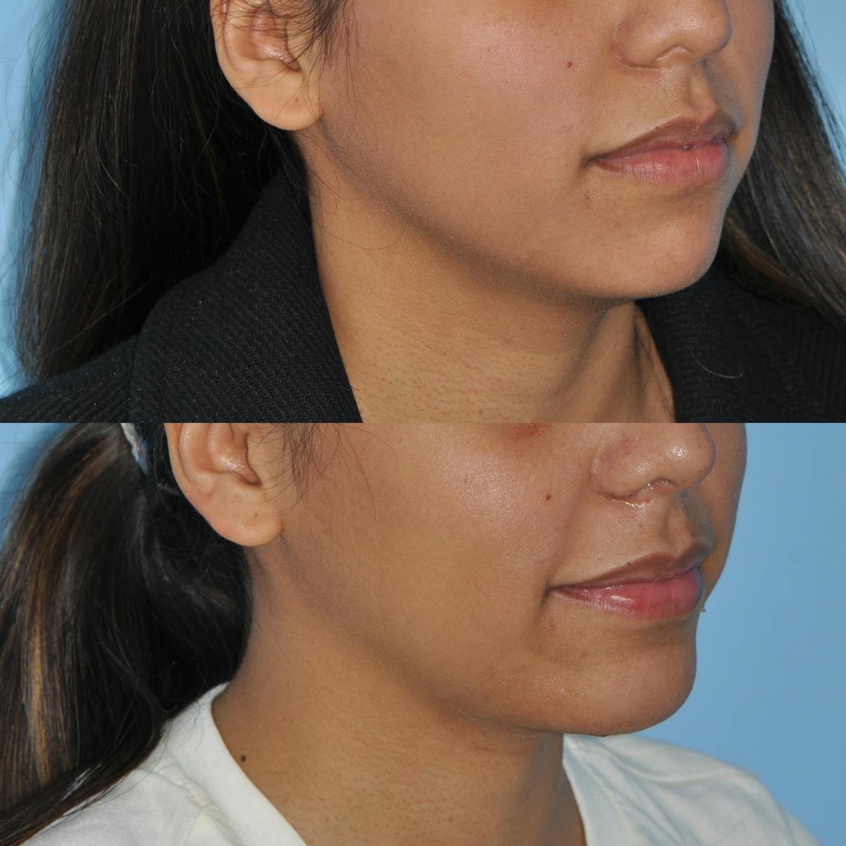 Chin Implants Before & After Gallery - Patient 102864 - Image 1