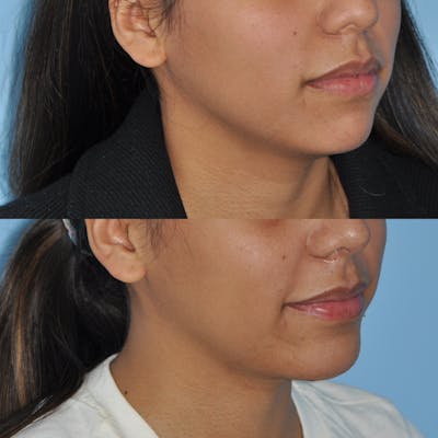 Chin Implants Before & After Gallery - Patient 102864 - Image 1
