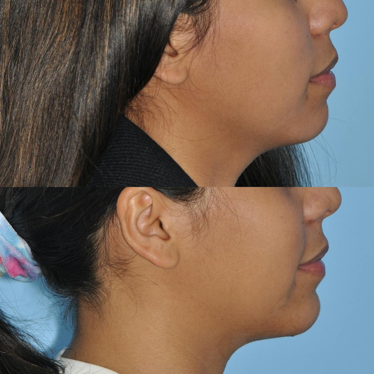 Chin Implants Before & After Gallery - Patient 102864 - Image 4
