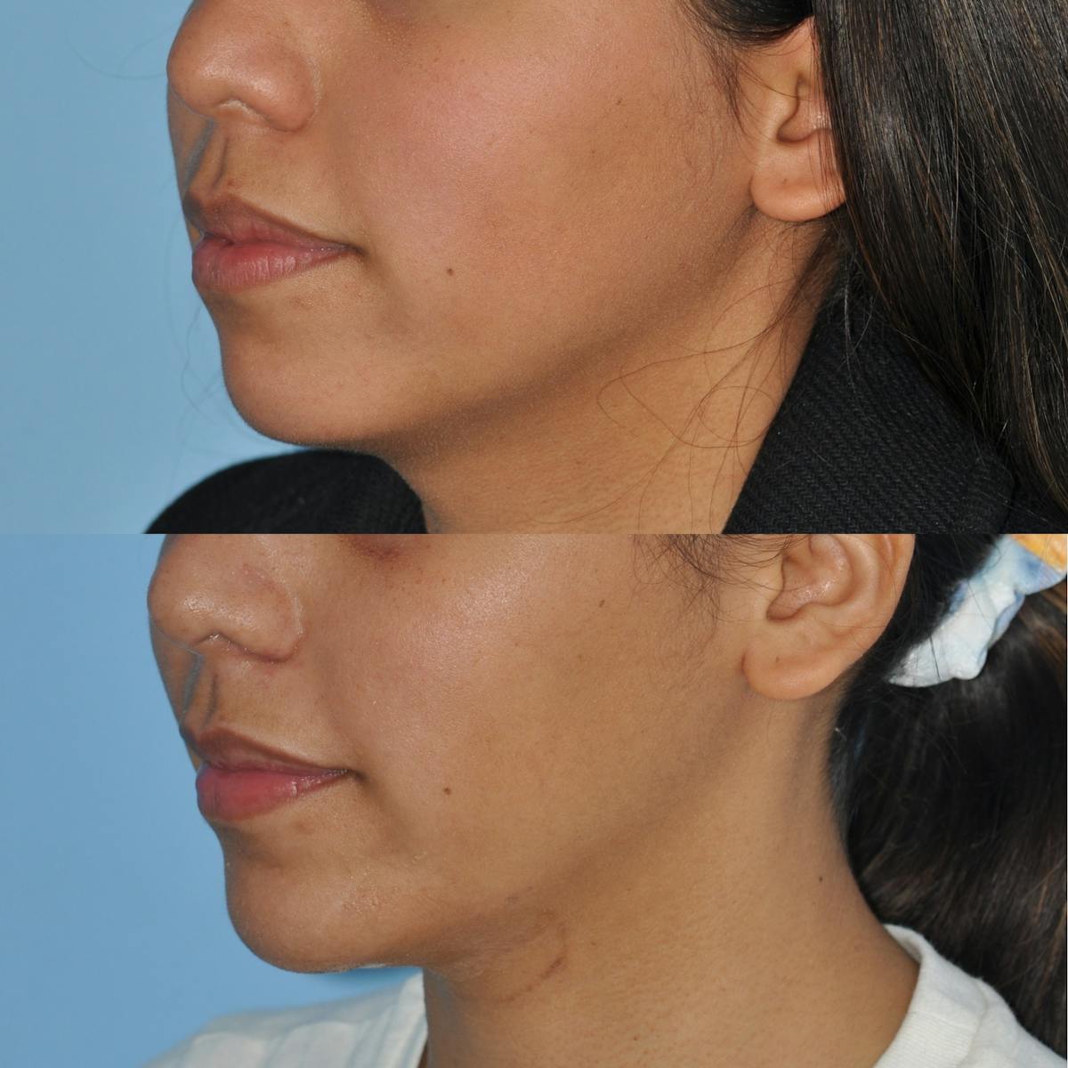 Chin Implants Before & After Gallery - Patient 102864 - Image 5