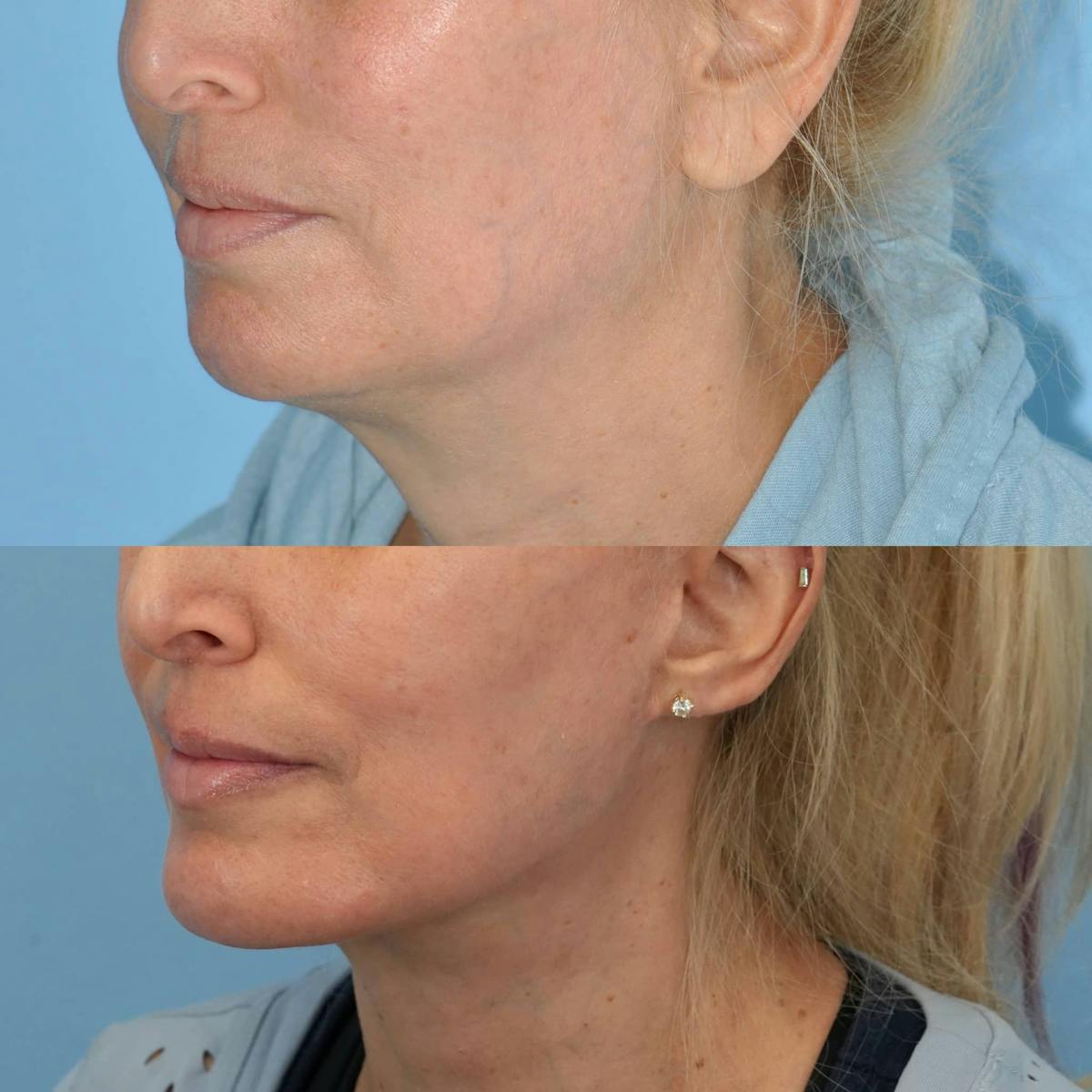 Chin Implants Before & After Gallery - Patient 266115 - Image 1
