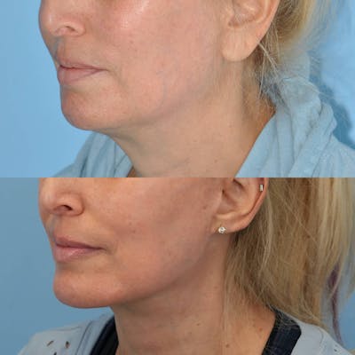 Chin Implants Before & After Gallery - Patient 266115 - Image 1