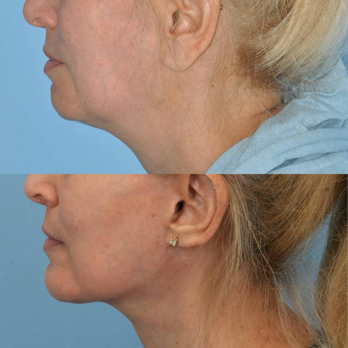 Chin Implants Before & After Gallery - Patient 266115 - Image 2