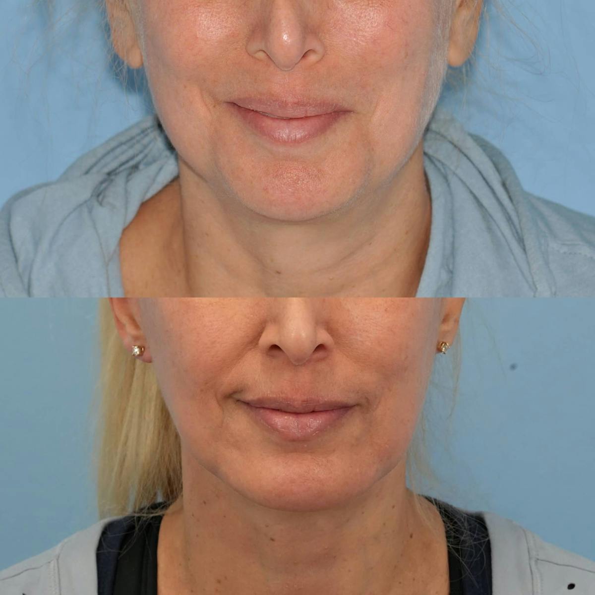 Chin Implants Before & After Gallery - Patient 266115 - Image 3