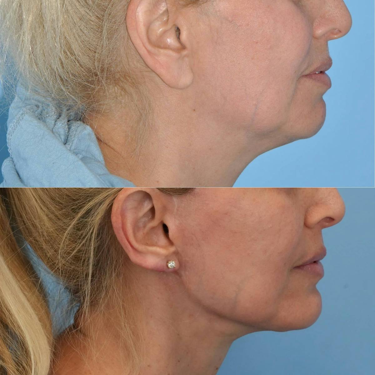 Chin Implants Before & After Gallery - Patient 266115 - Image 5