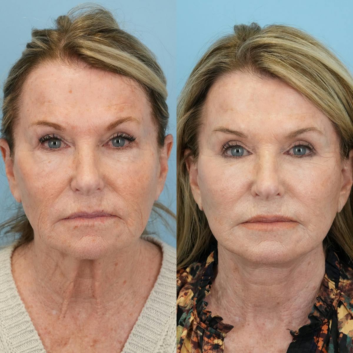 Facelift Before & After Gallery - Patient 827816 - Image 1