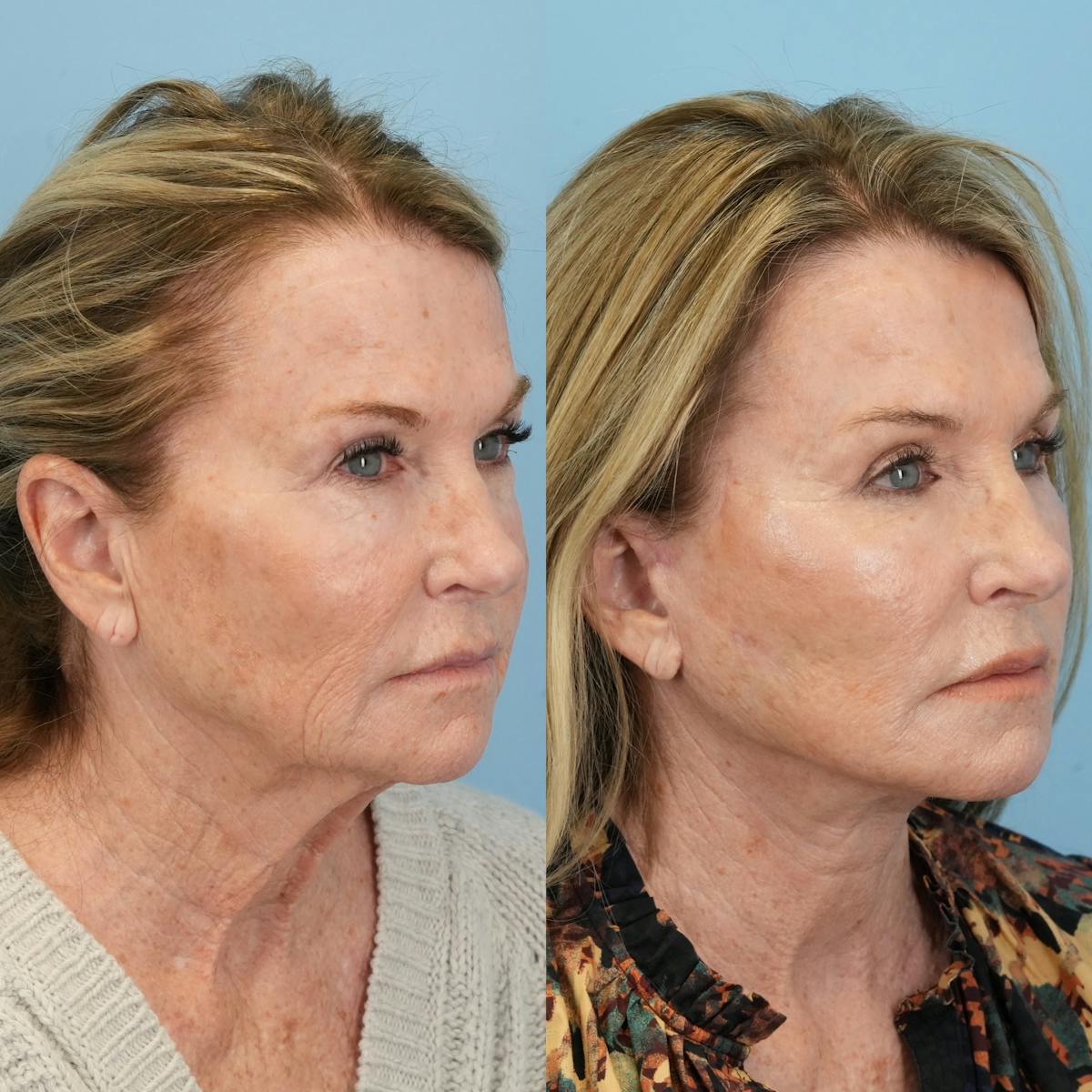 Facelift Before & After Gallery - Patient 827816 - Image 3