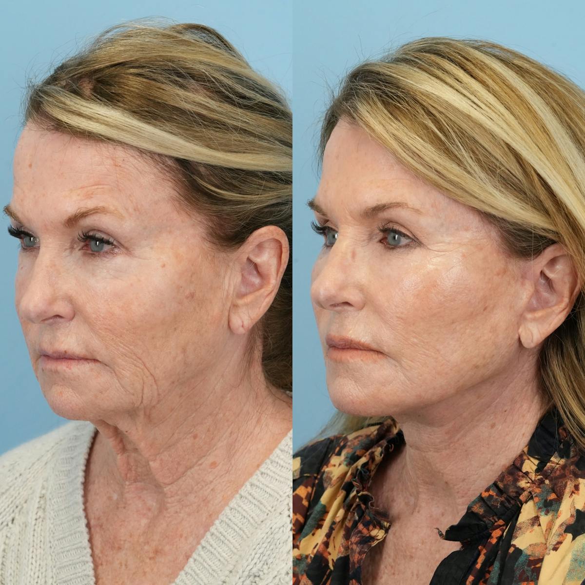 Facelift Before & After Gallery - Patient 827816 - Image 5