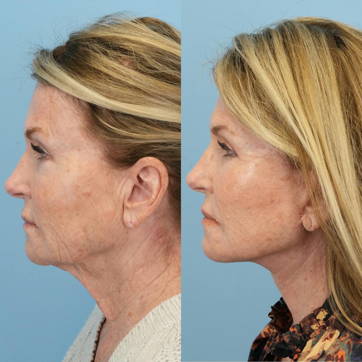 Facelift Before & After Gallery - Patient 827816 - Image 6