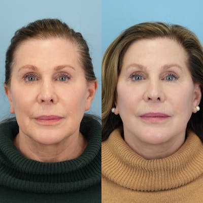 Facelift Before & After Gallery - Patient 193519 - Image 1