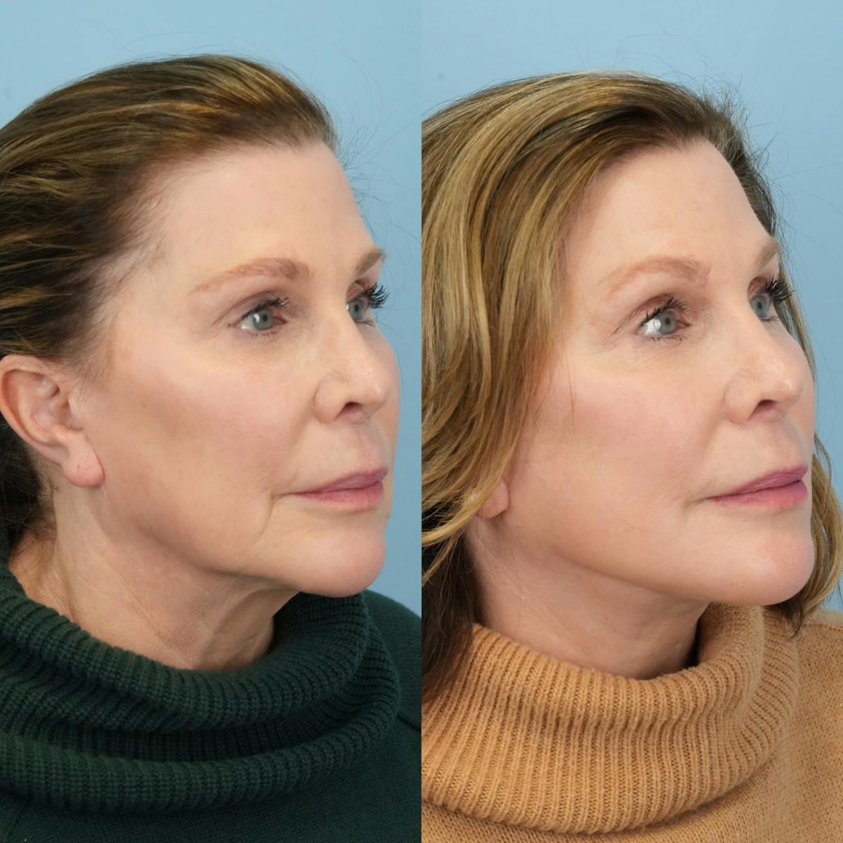 Facelift Before & After Gallery - Patient 193519 - Image 2