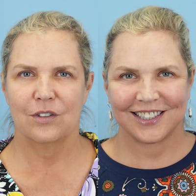 Facelift Before & After Gallery - Patient 132874 - Image 1