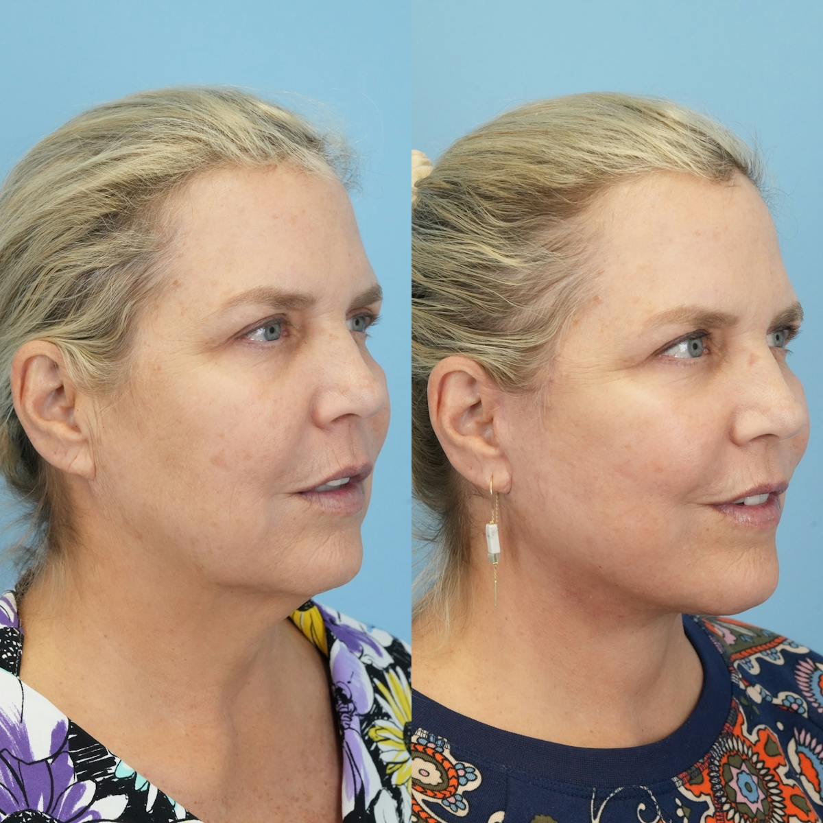 Facelift Before & After Gallery - Patient 132874 - Image 2