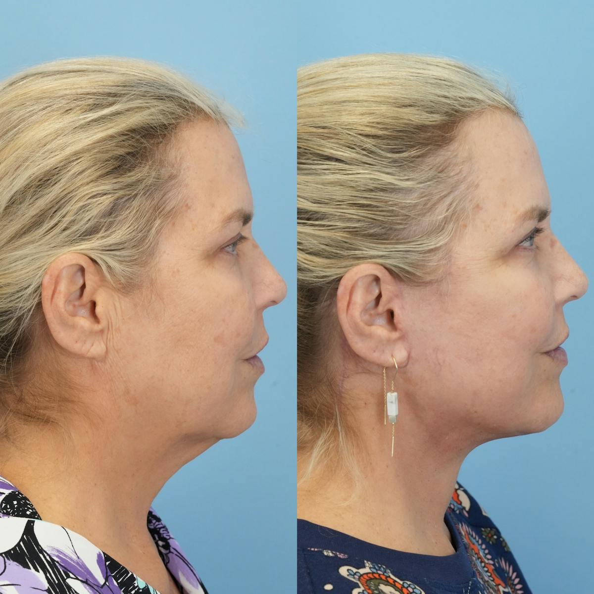 Facelift Before & After Gallery - Patient 132874 - Image 3