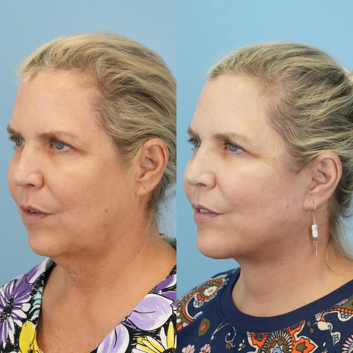 Facelift Before & After Gallery - Patient 132874 - Image 4