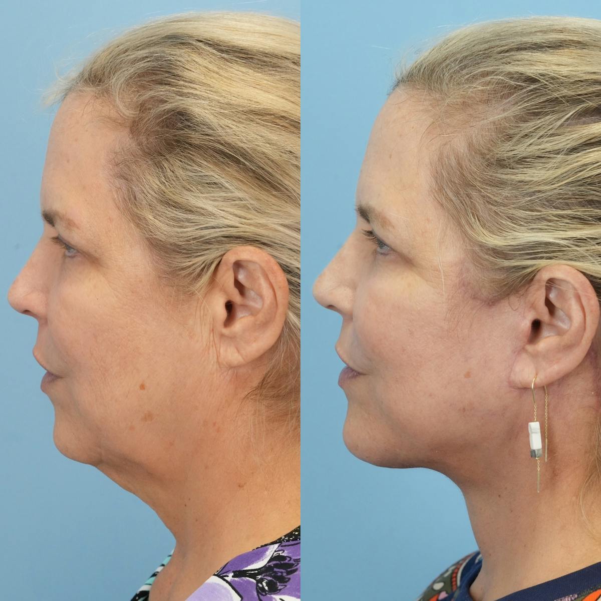 Facelift Before & After Gallery - Patient 132874 - Image 5
