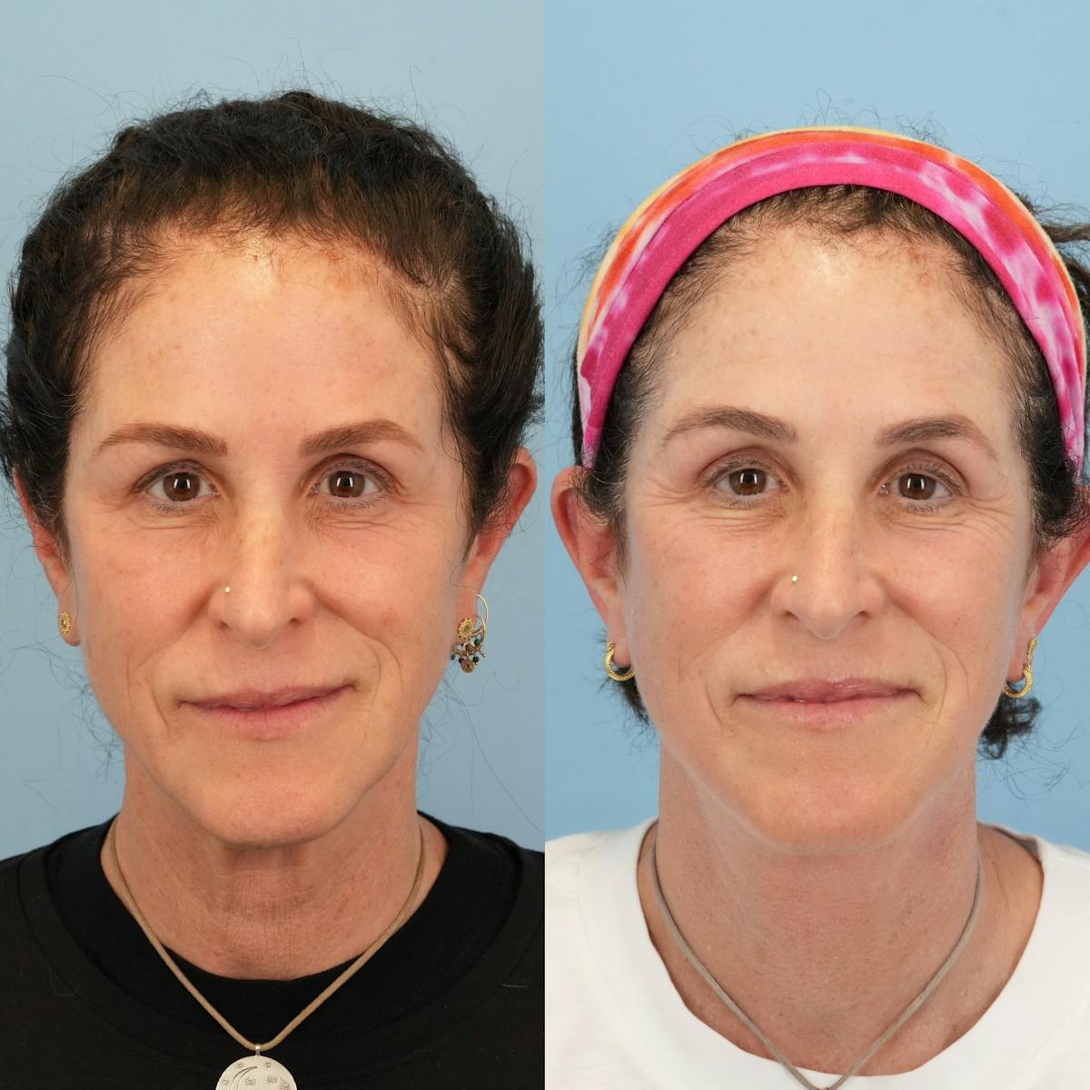Facelift Before & After Gallery - Patient 379385 - Image 1