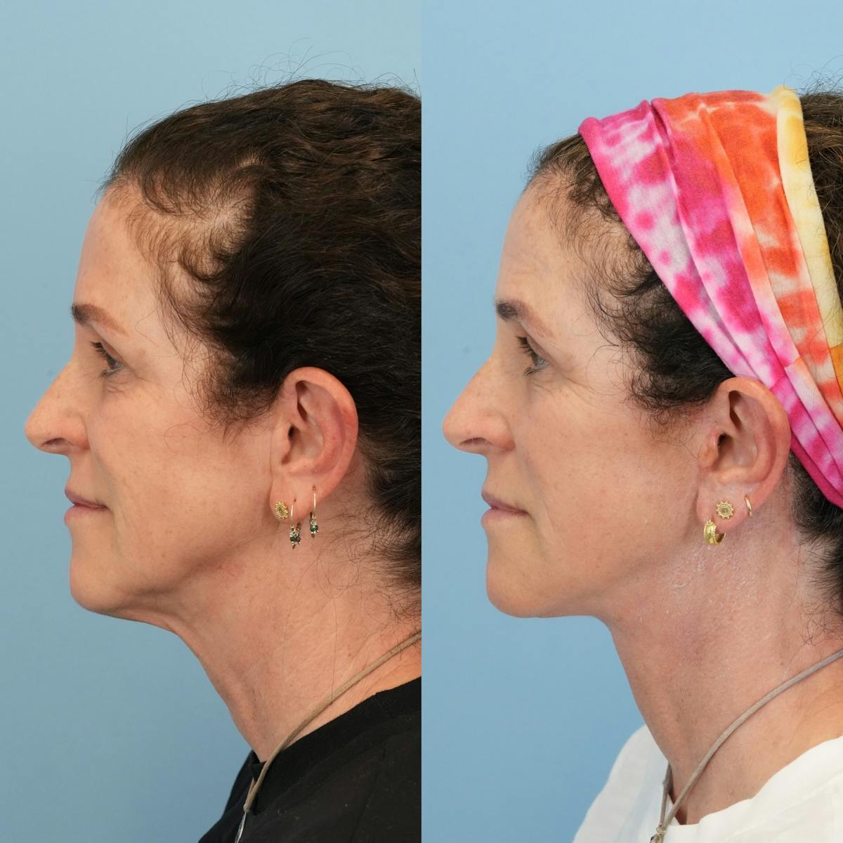 Facelift Before & After Gallery - Patient 379385 - Image 5