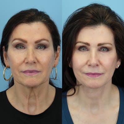 Facelift Before & After Gallery - Patient 887525 - Image 1