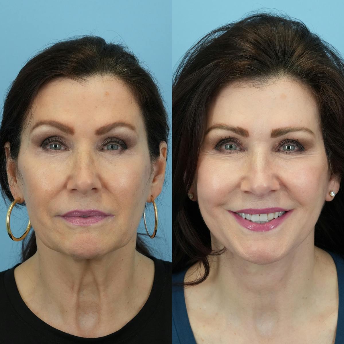 Facelift Before & After Gallery - Patient 887525 - Image 2