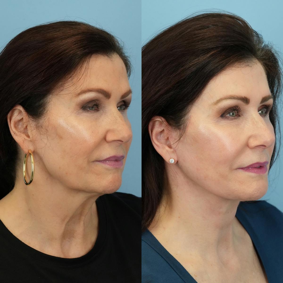 Facelift Before & After Gallery - Patient 887525 - Image 3