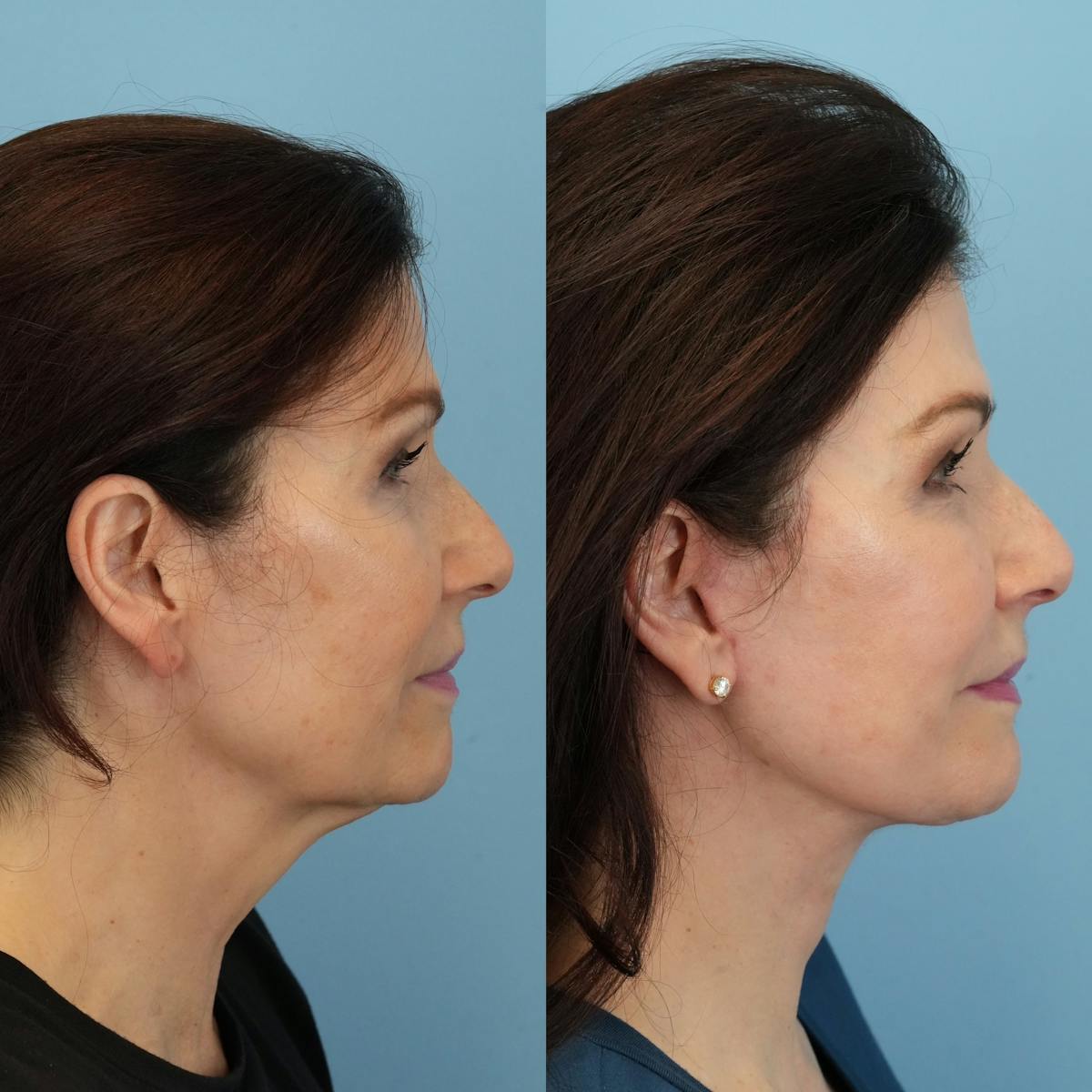 Facelift Before & After Gallery - Patient 887525 - Image 4