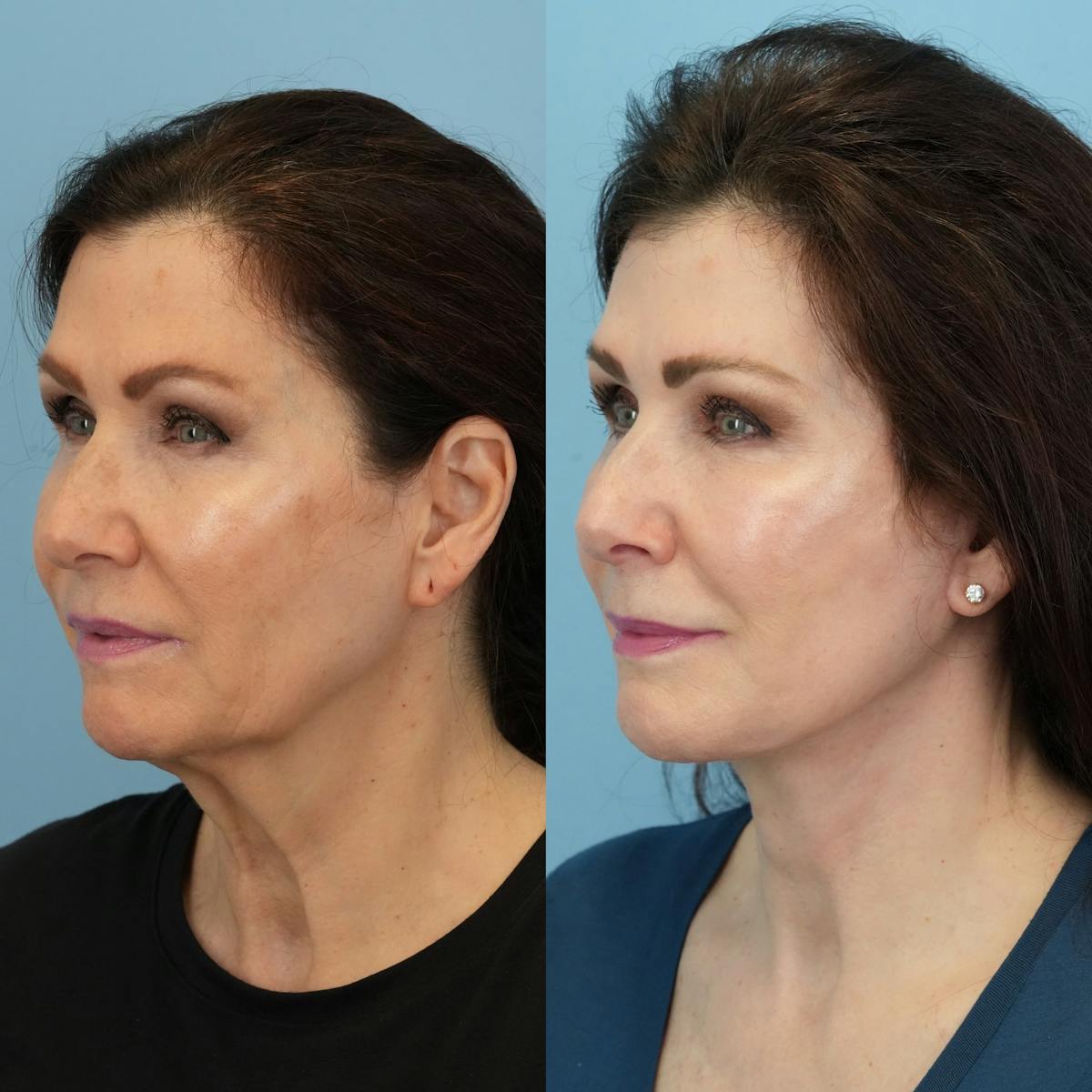 Facelift Before & After Gallery - Patient 887525 - Image 5