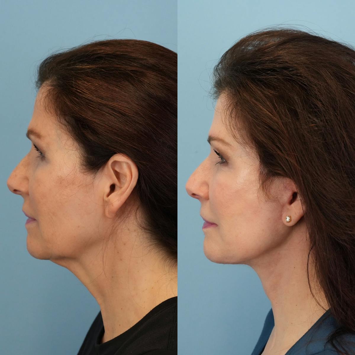 Facelift Before & After Gallery - Patient 887525 - Image 6