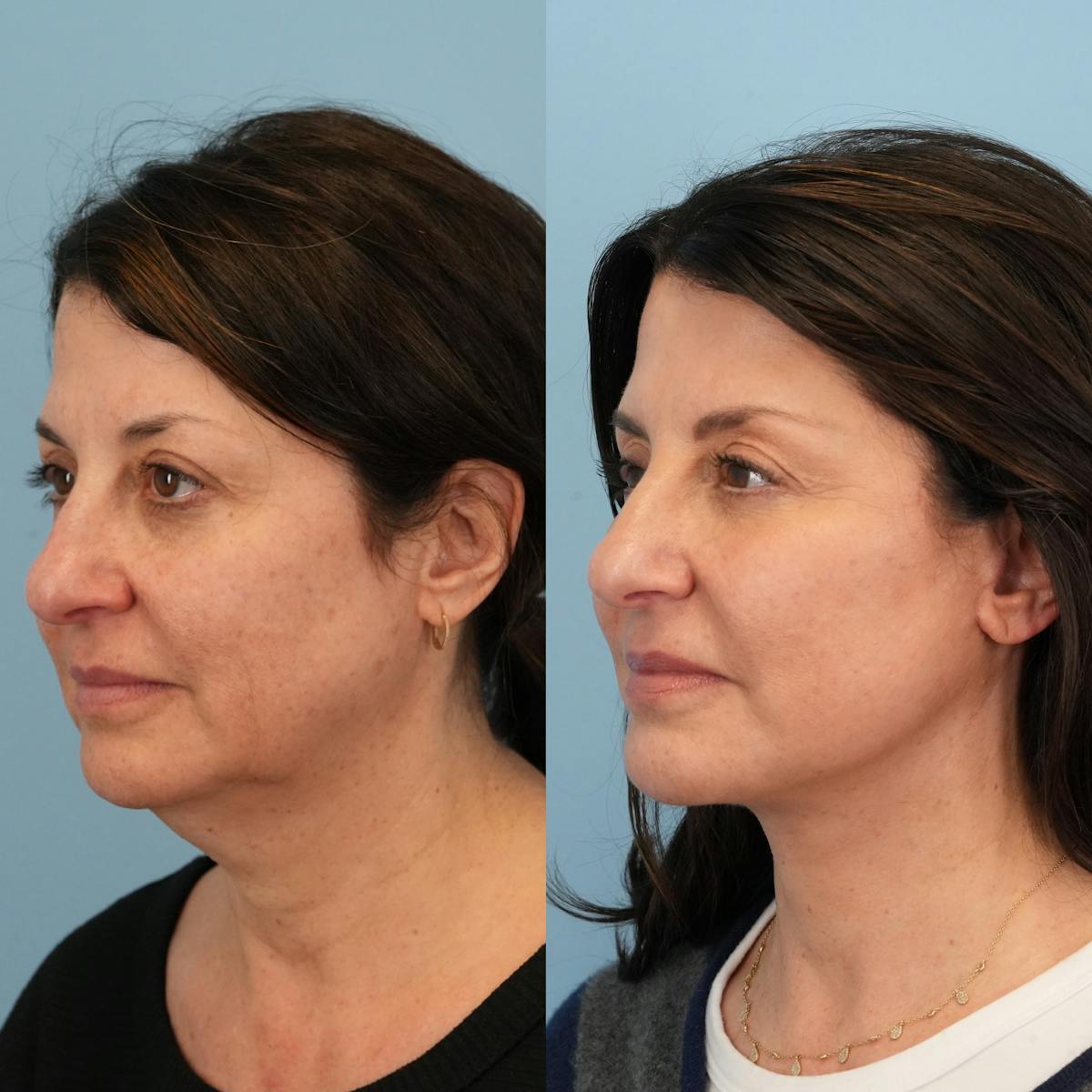 Facelift Before & After Gallery - Patient 258538 - Image 4