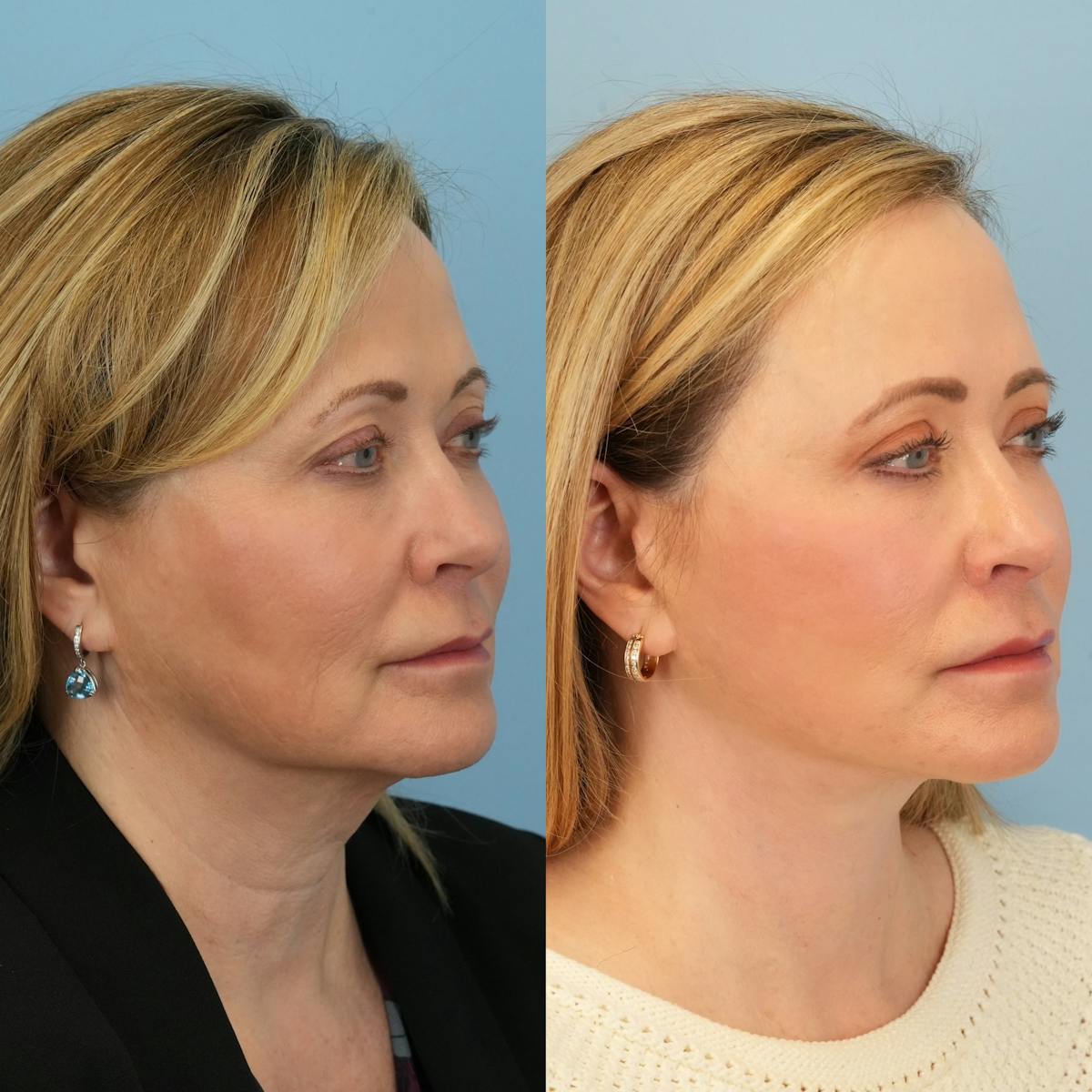 Facelift Before & After Gallery - Patient 248953 - Image 2