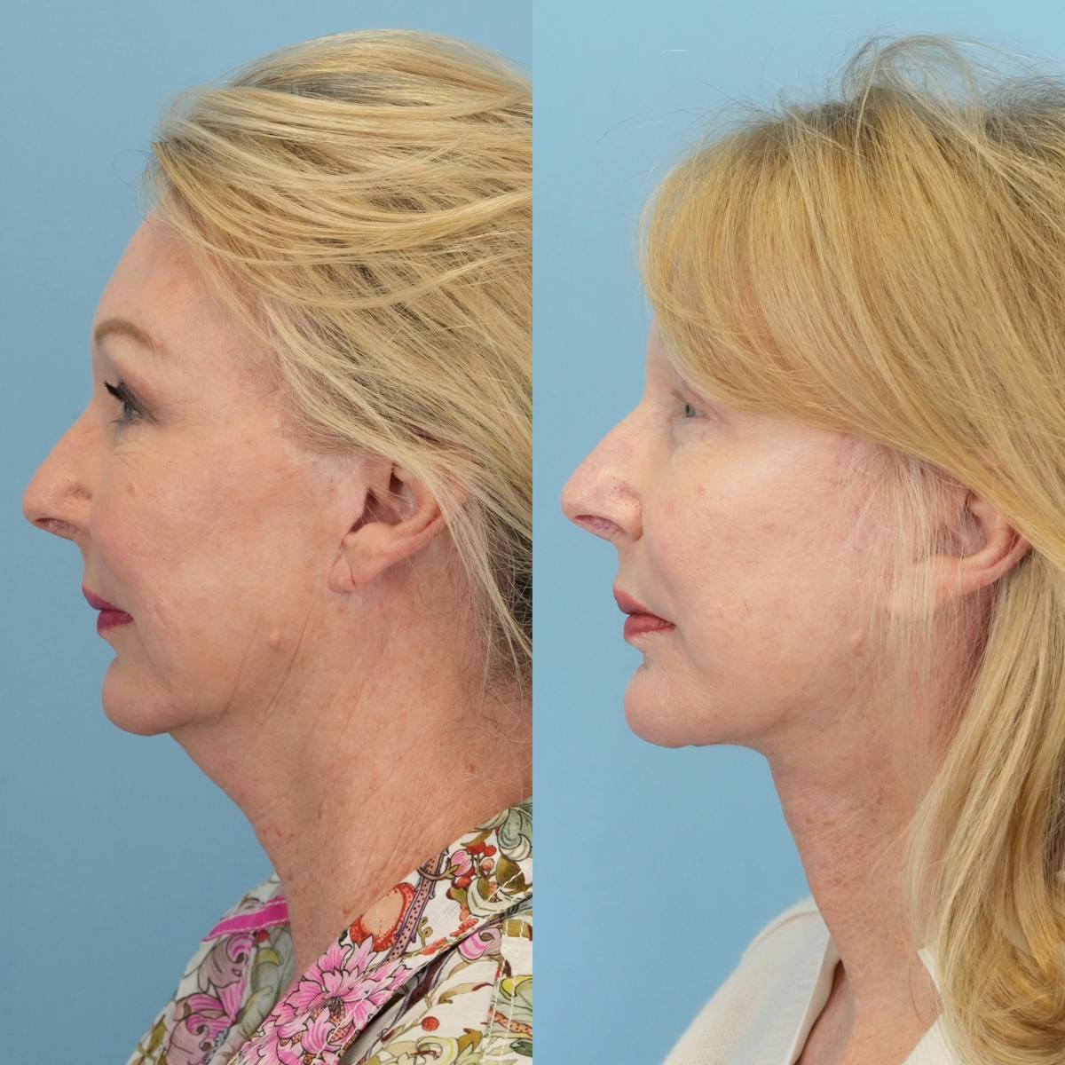 Facelift Before & After Gallery - Patient 330864 - Image 5