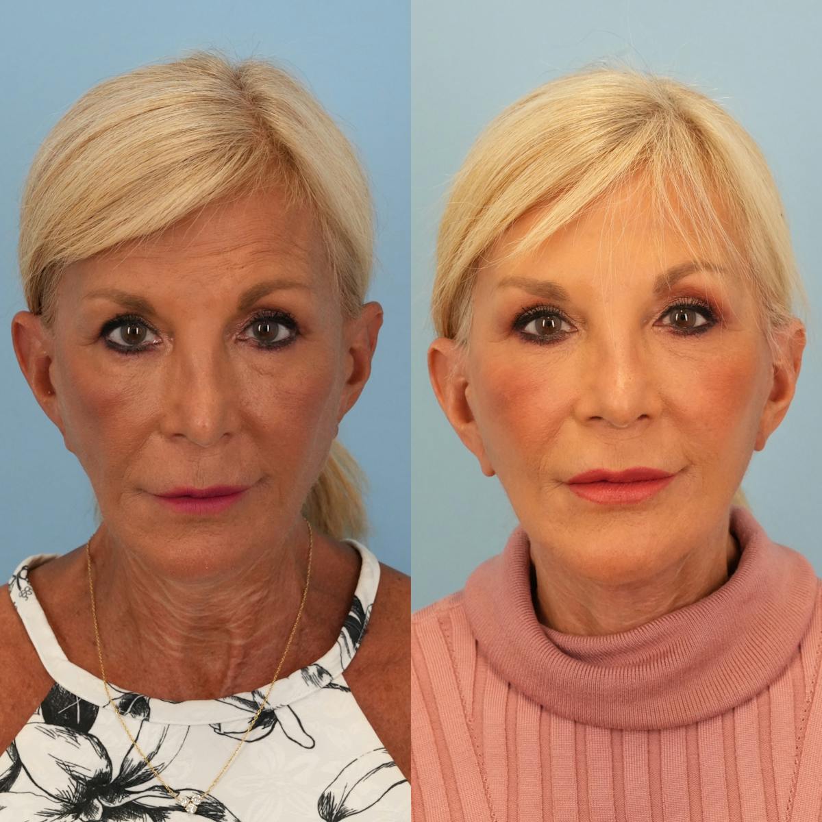 Facelift Before & After Gallery - Patient 419183 - Image 1