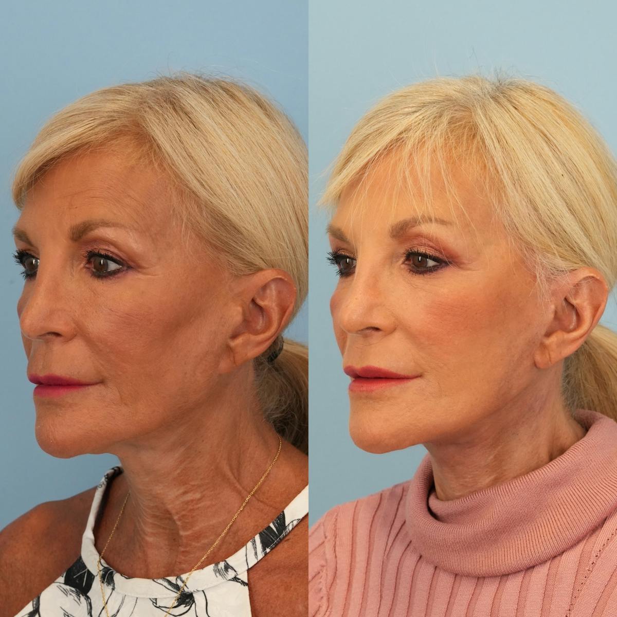 Facelift Before & After Gallery - Patient 419183 - Image 4